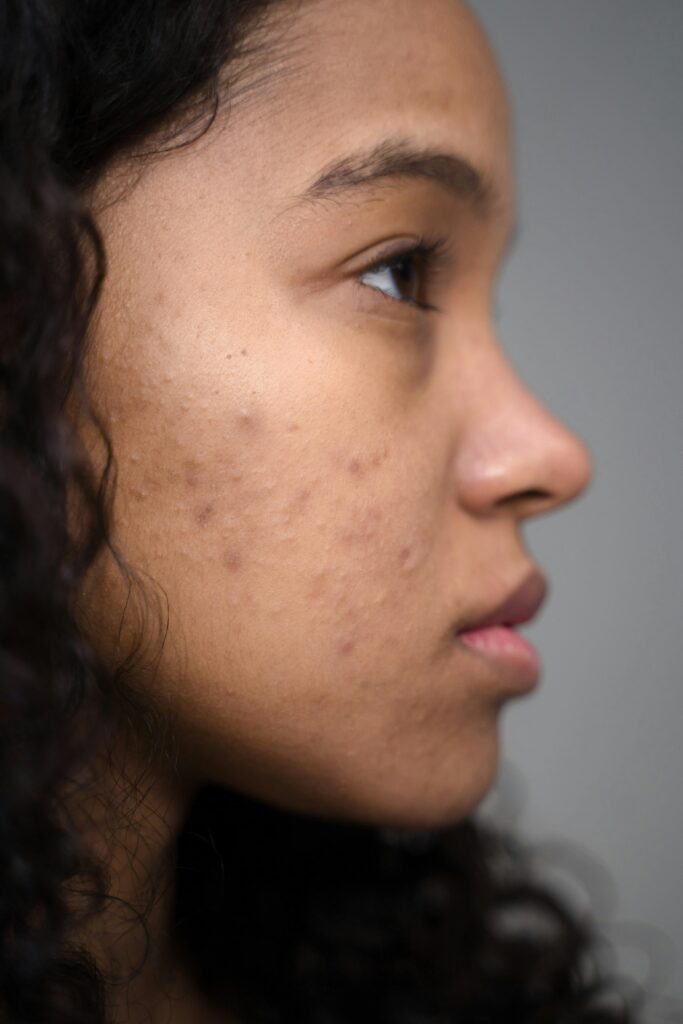 Close-up side profile of a woman showing natural skin with acne.